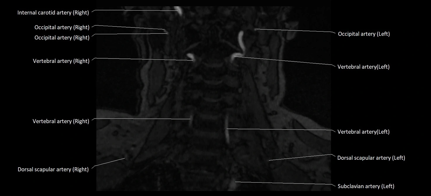 MRA carotid artery anatomy cross sectional 3T coronal image 11.webp